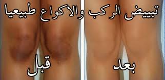 تبييض الركب والكوعين